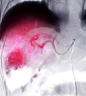 Transarterial Chemoembolization (TACE).