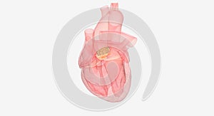 The Transcatheter aortic valve replacement