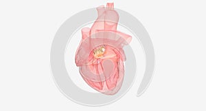 The Transcatheter aortic valve replacement