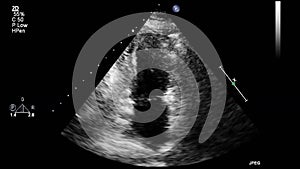 Transesophageal ultrasound examination of the heart