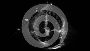 Transesophageal ultrasound examination of the heart