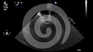 Transesophageal ultrasound examination of the heart