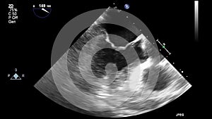 Transesophageal ultrasound examination of the heart