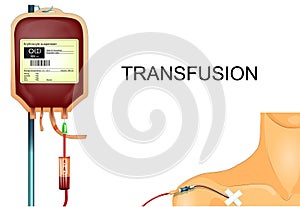 transfusion of donor blood to the patient through the subclavian catheter