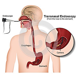 Transnasal endoscopy medical  illustration on white background photo