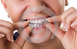 Transparent teeth braces
