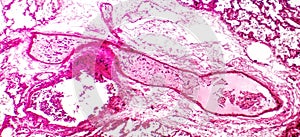 Transparent thrombosis, light micrograph