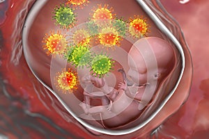 Transplacental transmission of Cytomegalovirus to human embryo