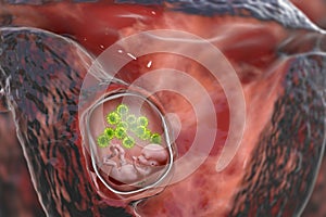 Transplacental transmission of Cytomegalovirus to human embryo