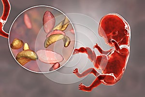 Transplacental transmission of Toxoplasma gondii parasites to human embryo