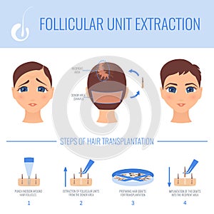 Transplantation with FUE in women