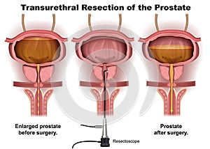 Transurethral Resection 3d illustration medical vector infographic with english description