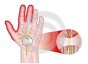 Transverse carpal ligament photo