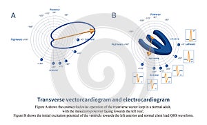 Transverse vectorcardiogram and electrocardiogram