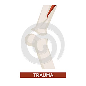 Trauma health damage with bone fracture close up