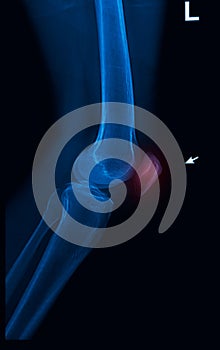 Trauma knee joint x-rays image