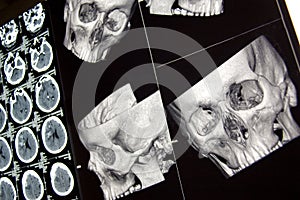 Traumatic brain injury, head bones and brain, CT