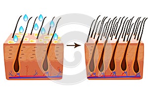 Treatment of alopecia. Vitamins hair. Biotin. Seborrhea skin and hair. Dandruff, seborrheic dermatitis. Baldness, hair