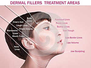 Treatment areas for anti-wrinkle injection