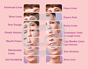 Treatment areas for anti-wrinkle injection.