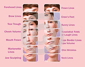 Treatment areas for anti-wrinkle injection. photo
