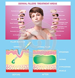 Treatment areas for anti-wrinkle injection. Young female with clean fresh skin. Beautiful woman. Female face and neck