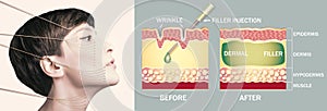 Treatment areas for anti-wrinkle injection. Young female with clean fresh skin. Beautiful woman. Female face and neck photo