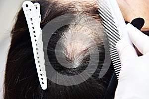 Treatment of baldness with beauty injections. Cosmetologist`s hands in gloves make a subcutaneous injection.