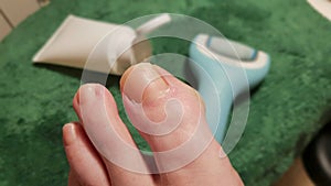 Treatment of a callus of a toe