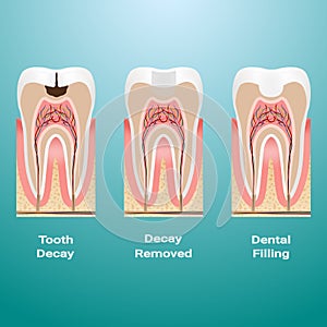 Treatment Of Caries. Dental Filling. Dental Caries Detailed Isolated On A Background. Vector Illustration.