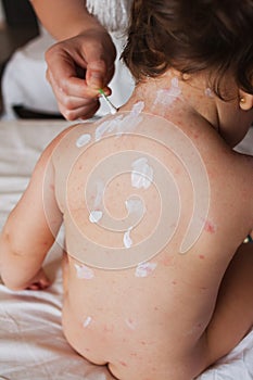 Treatment for chicken pox