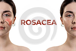 Treatment of couperose. Two half female portraits showing the result of treatment. White background with ROSACEA text