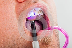 Treatment with dental polymerization lamp