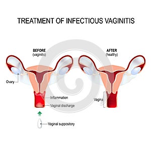 Treatment of infectious vaginitis photo