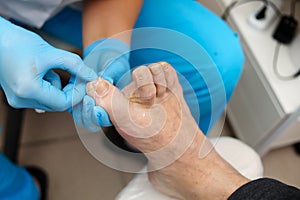 Treatment of an ingrown toenail for a man. Relief of pain. Podology treatment. Podiatrist treating toenail fungus photo
