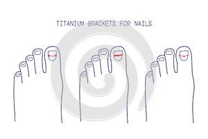 Treatment of ingrown toenail with titanium brackets different types. Hand drawn vector illustration