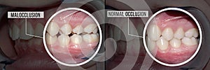 Treatment malocclusion: before and after