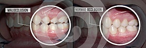 Treatment malocclusion: before and after photo