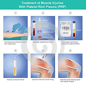Treatment of Muscle Injuries With Platelet Rich Plasma. Diagram treatment of muscle injuries a knee from blood platelet photo