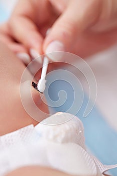 Treatment of newborn baby navel with cotton swab