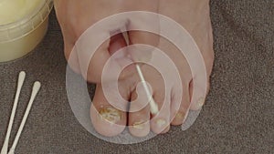 Treatment of patients with onycholysis of toenails with medicine.