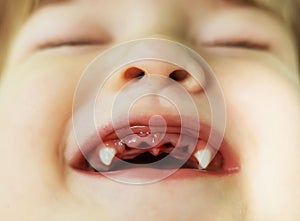 Treatment and removal of teeth in children. Close-up of a beautiful little girl lying at home showing her mouth with her baby teet