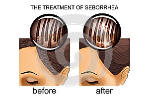 The treatment of seborrhea of the scalp. before and after