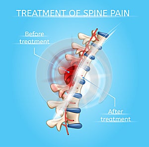 Treatment of Spine Pain Realistic Vector Chart