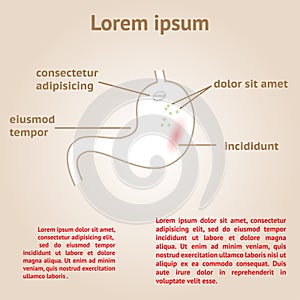 Treatment of stomach ache