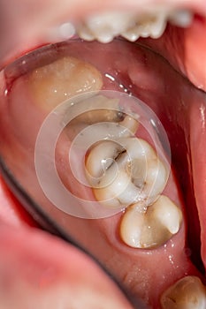 Treatment of tooth decay with subsequent filling with photopolymer material. Close-up, macro