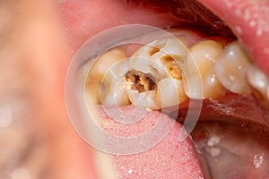 Treatment of tooth decay with subsequent filling with photopolymer material. Close-up, macro photo