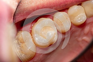 Treatment of tooth decay with subsequent filling with photopolymer material. Close-up, macro
