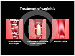 Treatment of vaginitis suppositories. inflammation the vagina. Infographics. vector illustration