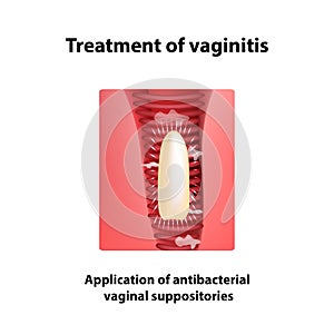 Treatment of vaginitis suppositories. inflammation the vagina. Infographics. vector illustration on isolated background photo